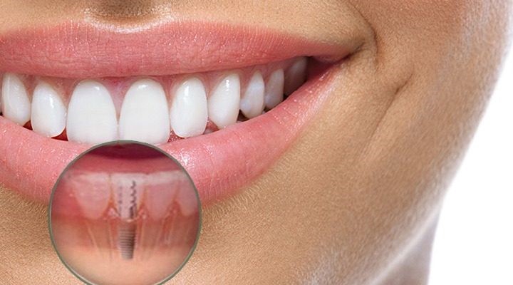 Implantologia (Implantes Dentários)